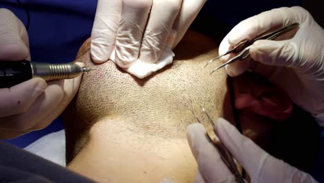 Ärzte,-Die-Bartfollikel-Für-Die-Haartransplantation-In-Der-Regenerationsklinik-Ernten