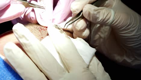 Ärzte-Entnehmen-Einzelne-Haarfollikel-Aus-Dem-Bart-Mit-Der-Fue-Methode-Für-Die-Transplantation