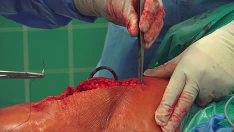 Chirurgisches-Nahtmaterial-Ist-Ein-Medizinisches-Gerät,-Das-Verwendet-Wird,-Um-Körpergewebe-Nach-Einer-Verletzung-Oder-Operation-Zusammenzuhalten