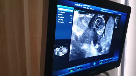 Fetal-Ultrasound-screen-showing-baby-in-womb